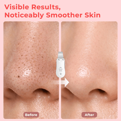 Ultrasonic Shovel BEAUTY START - Skin Scrubber, Face Spatula For Blackhead Removal And Cleansing Pores_img_14